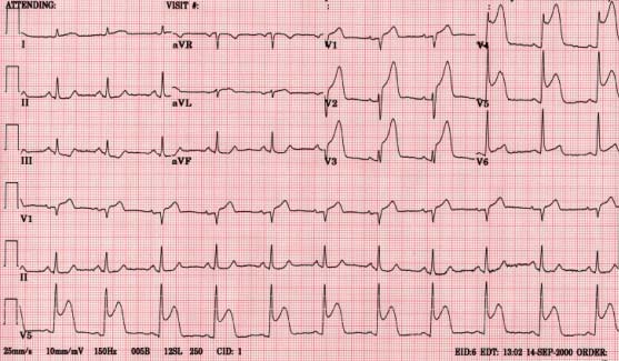 ecg