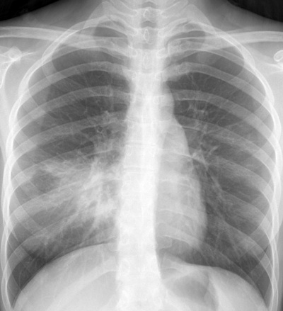 cxr pneumonia