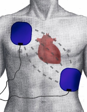 defib_pacing