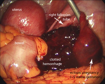 is reglan safe in first trimester