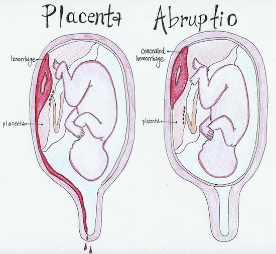 abruption