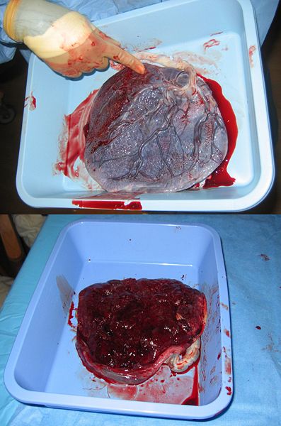 placenta