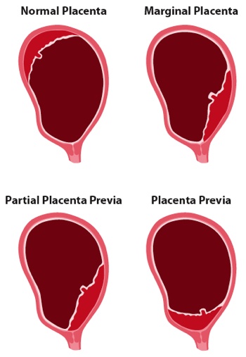 placenta previa