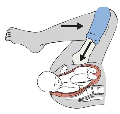 shoulder_dystocia