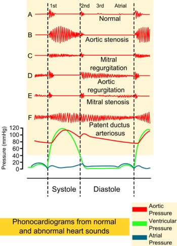 Aortic Regurgitation Murmur