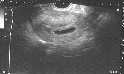 anembryonic sac