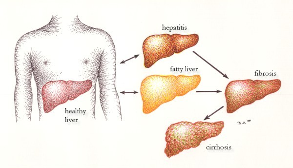 liver damage